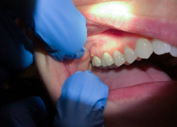 Best Emergency Root Canal Treatment in Flowery Branch, GA